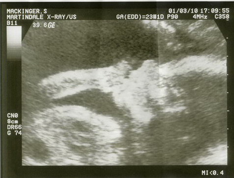 Ultraschallbilder vom 1. Maerz 2010