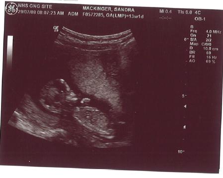 14. Schwangerschaftswoche