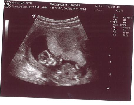 14. Schwangerschaftswoche