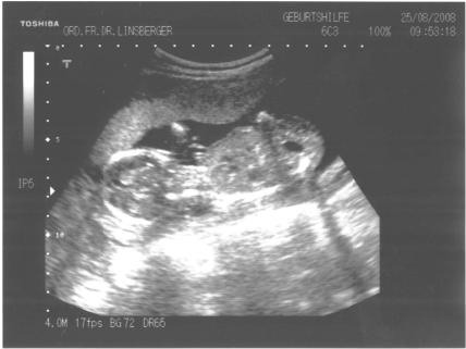 18. Schwangerschaftswoche