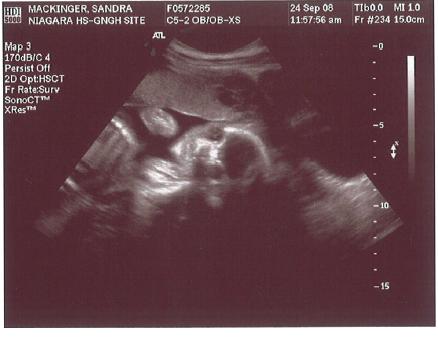 22. Schwangerschaftswoche