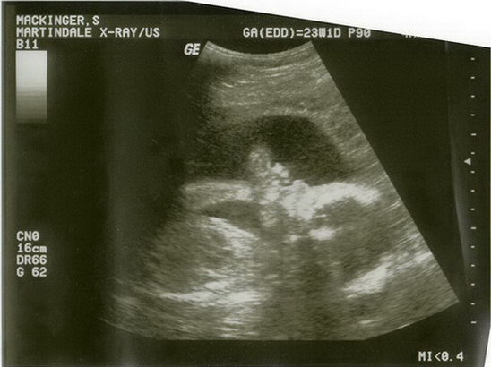 Ultraschallbilder vom 1. Maerz 2010