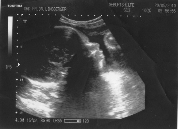 Ultraschallbilder vom 1. Maerz 2010