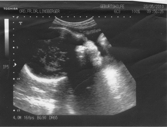 Ultraschallbilder vom 1. Maerz 2010